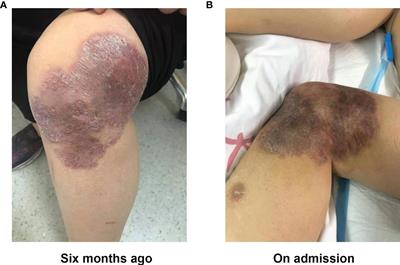 Encephalomyelitis Caused by Balamuthia mandrillaris in a Woman With Breast Cancer: A Case Report and Review of the Literature